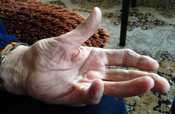 Triumph LTD provides arthritis treatment